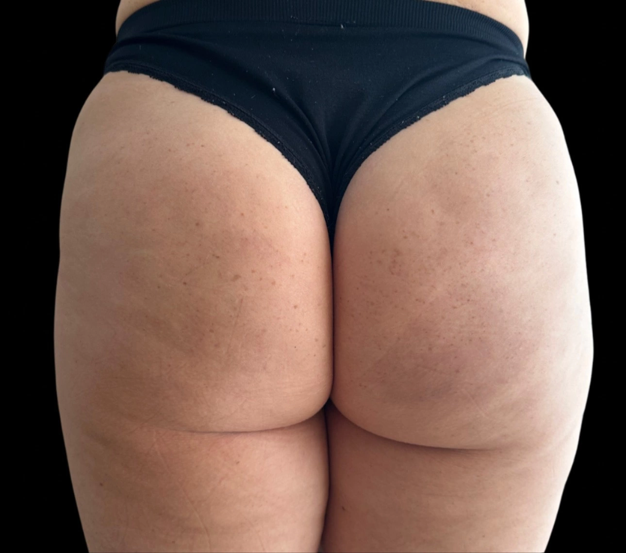 gluteo3