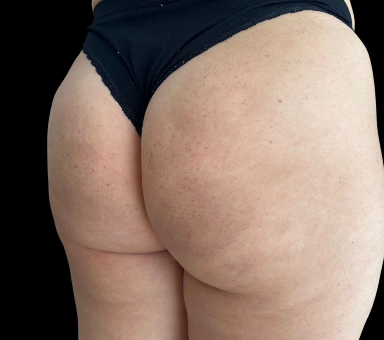gluteo4